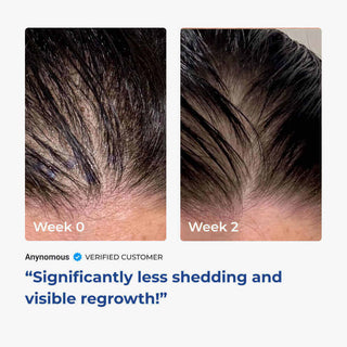 Before and after hair regrowth results, showing healthier hair and less oiliness in 12 weeks.