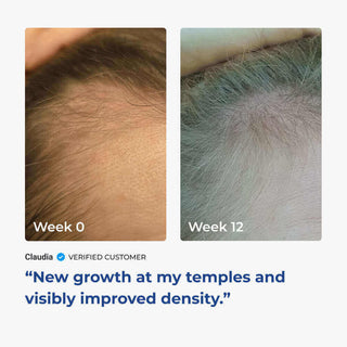 Before and after hair growth photos showing improvement in density at temples, verified customer Claudia's results.