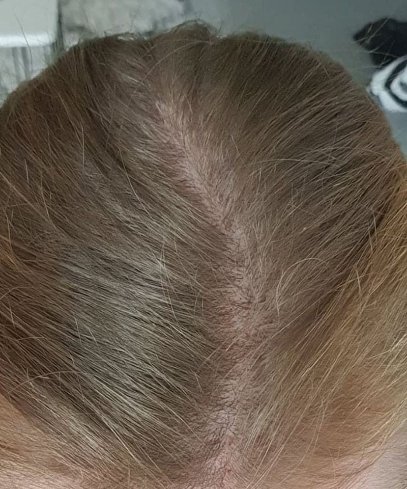 Week 12: K.W. · GHK-Cu Hair & Scalp Serum