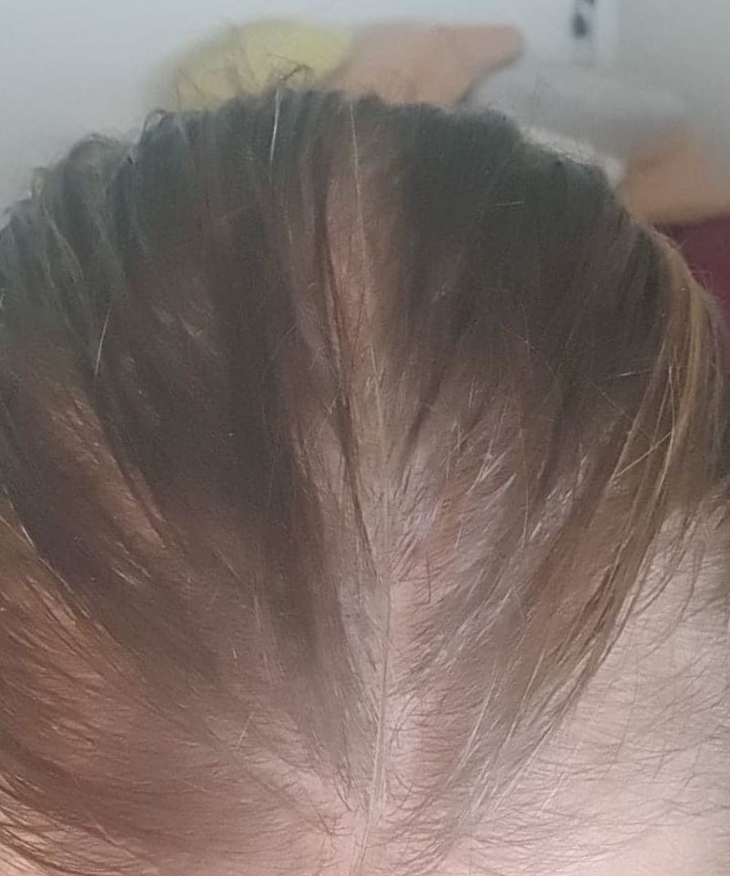 Before: K.W. · GHK-Cu Hair & Scalp Serum