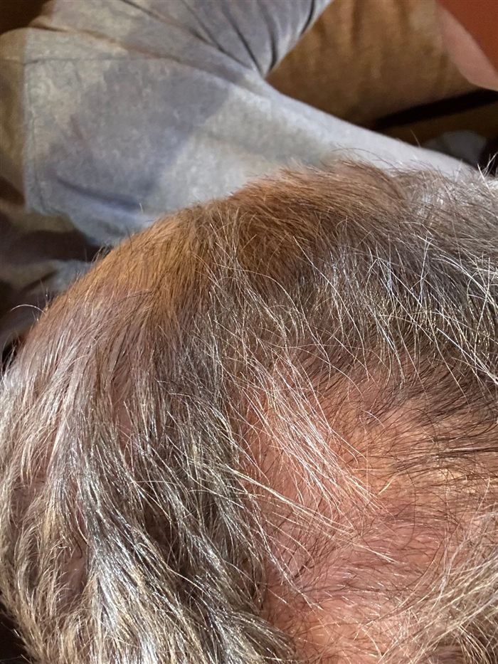 Joseph B. · GHK-Cu Hair & Scalp Serum, customer photo